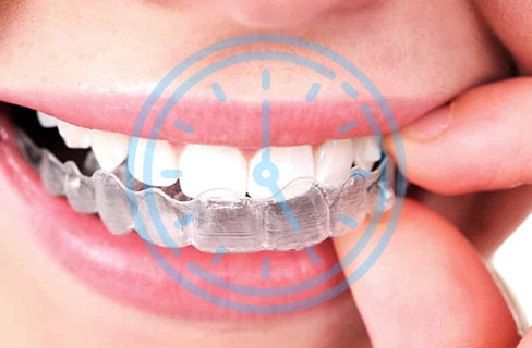 Invisalign: O aparelho dental invisível